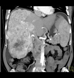 Hepatocellular Carcinoma (Hepatoma) - CTisus CT Scan