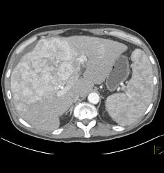 Hepatocellular Carcinoma (Hepatoma) - CTisus CT Scan