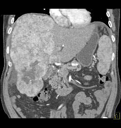 Hepatocellular Carcinoma (Hepatoma) - CTisus CT Scan