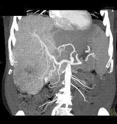 Hepatocellular Carcinoma (Hepatoma) - CTisus CT Scan