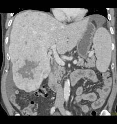 Hepatocellular Carcinoma (Hepatoma) - CTisus CT Scan