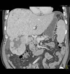 Hepatocellular Carcinoma (Hepatoma) - CTisus CT Scan