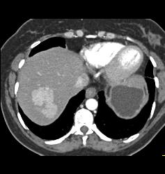 Focal Nodular Hyperplasia (FNH) - CTisus CT Scan