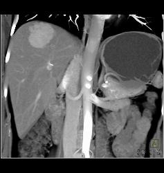 Focal Nodular Hyperplasia (FNH) - CTisus CT Scan