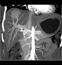 Focal Nodular Hyperplasia (FNH) - CTisus CT Scan