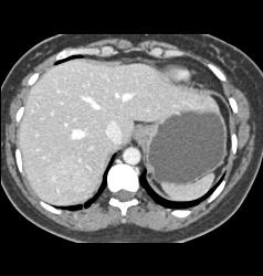 Focal Nodular Hyperplasia (FNH) - CTisus CT Scan