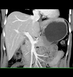 Focal Nodular Hyperplasia (FNH) - CTisus CT Scan