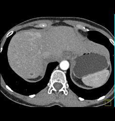 Multifocal Liver Metastases Best Seen on MIP Imaging - CTisus CT Scan