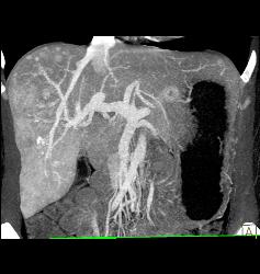 Multifocal Liver Metastases Best Seen on MIP Imaging - CTisus CT Scan