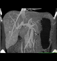 Multifocal Liver Metastases Best Seen on MIP Imaging - CTisus CT Scan