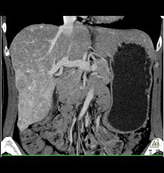 Multifocal Liver Metastases Best Seen on MIP Imaging - CTisus CT Scan