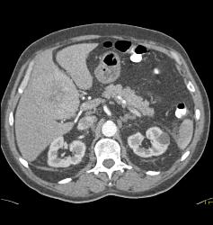 Hepatocellular Carcinoma (Hepatoma) - CTisus CT Scan