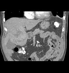 Hepatocellular Carcinoma (Hepatoma) - CTisus CT Scan