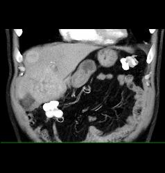 Hepatocellular Carcinoma (Hepatoma) - CTisus CT Scan