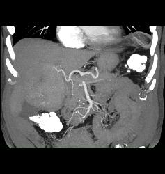 Hepatocellular Carcinoma (Hepatoma) - CTisus CT Scan