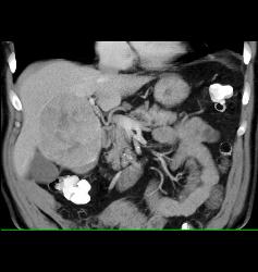 Hepatocellular Carcinoma (Hepatoma) - CTisus CT Scan