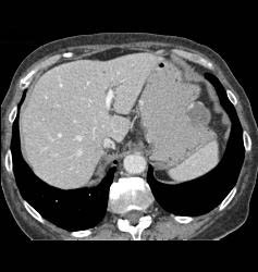 Gastric Cancer With Hemangioma of Liver Simulating A Vascular Mass - CTisus CT Scan