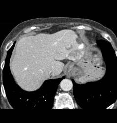 Gastric Cancer With Hemangioma of Liver Simulating A Vascular Mass - CTisus CT Scan