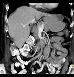 Gastric Cancer With Hemangioma of Liver Simulating A Vascular Mass - CTisus CT Scan