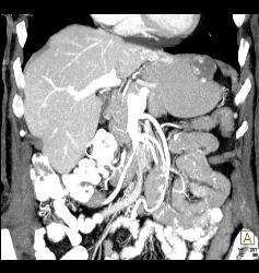 Gastric Cancer With Hemangioma of Liver Simulating A Vascular Mass - CTisus CT Scan