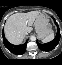 Gastric Cancer With Hemangioma of Liver Simulating A Vascular Mass - CTisus CT Scan