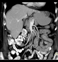 Gastric Cancer With Hemangioma of Liver Simulating A Vascular Mass - CTisus CT Scan