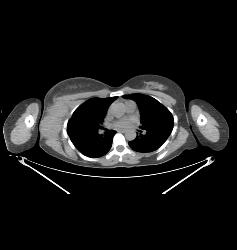 Melanoma Metastatic to Liver, Spleen and Accessory Spleen - CTisus CT Scan