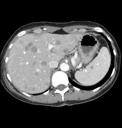 Melanoma Metastatic to Liver, Spleen and Accessory Spleen - CTisus CT Scan