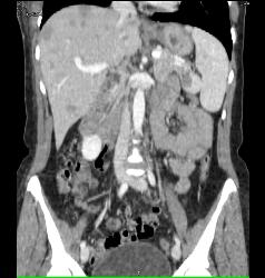 Melanoma Metastatic to Liver, Spleen and Accessory Spleen - CTisus CT Scan