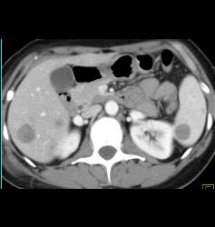 Metastatic Melanoma to Liver and Spleen and Accessory Spleen - CTisus CT Scan