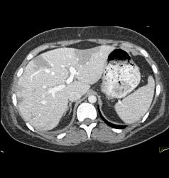 Hepatic Infarcts - CTisus CT Scan