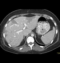 Hepatic Infarcts - CTisus CT Scan