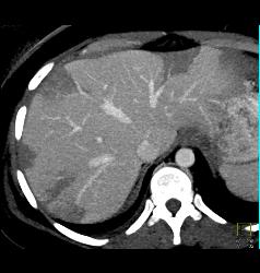 Hepatic Infarcts - CTisus CT Scan