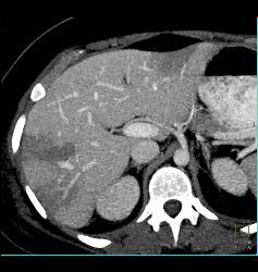 Hepatic Infarcts - CTisus CT Scan