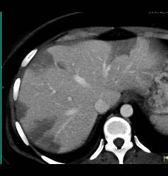 Hepatic Infarcts - CTisus CT Scan