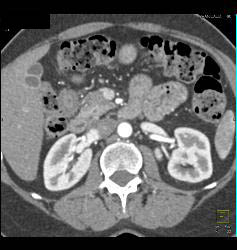 Septated Gallbladder - CTisus CT Scan