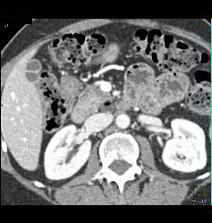 Septated Gallbladder - CTisus CT Scan