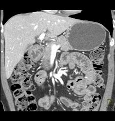 Septated Gallbladder - CTisus CT Scan