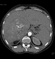 Hepatocellular Carcinoma (Hepatoma) With Neovascularity - CTisus CT Scan