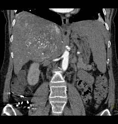 Hepatocellular Carcinoma (Hepatoma) With Neovascularity - CTisus CT Scan