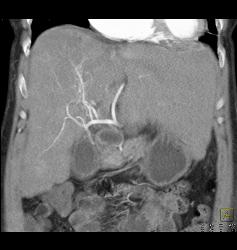 Hepatocellular Carcinoma (Hepatoma) With Neovascularity - CTisus CT Scan