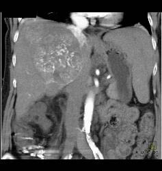 Hepatocellular Carcinoma (Hepatoma) With Neovascularity - CTisus CT Scan