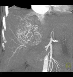 Hepatocellular Carcinoma (Hepatoma) With Neovascularity - CTisus CT Scan