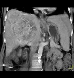 Hepatocellular Carcinoma (Hepatoma) With Neovascularity - CTisus CT Scan