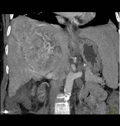 Hepatocellular Carcinoma (Hepatoma) With Neovascularity - CTisus CT Scan