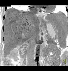 Hepatocellular Carcinoma (Hepatoma) With Neovascularity - CTisus CT Scan