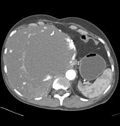 Giant Hemangioma - CTisus CT Scan