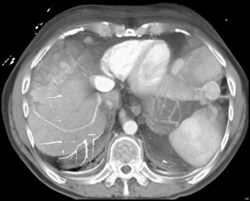 Implants on Liver Surface - CTisus CT Scan