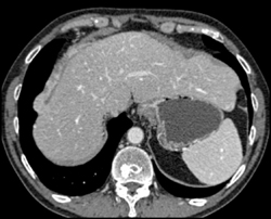 Implants on Liver Surface - CTisus CT Scan