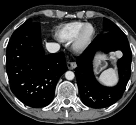 Implants on Liver Surface - CTisus CT Scan